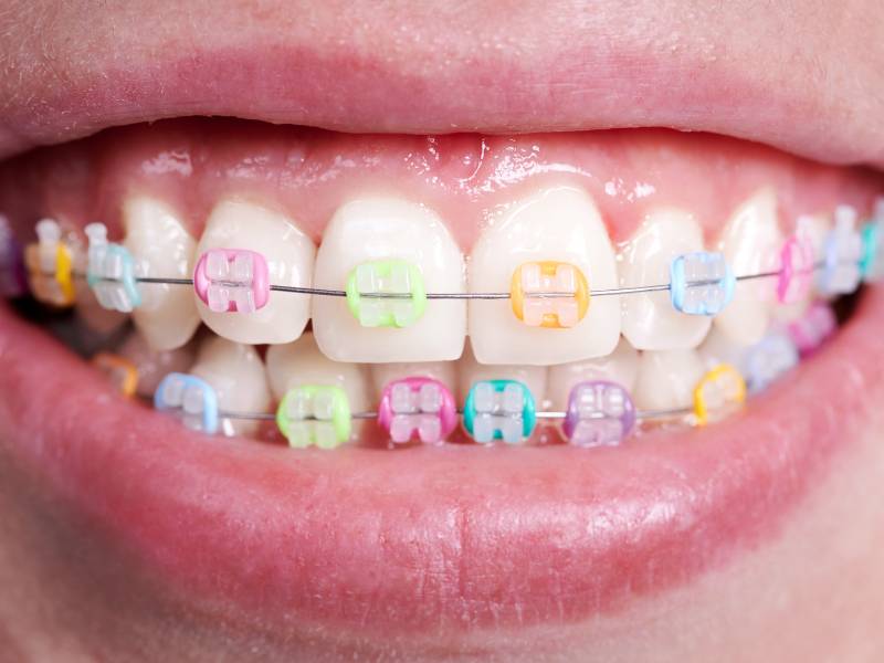 Colorful braces for children at Trü Orthodontics